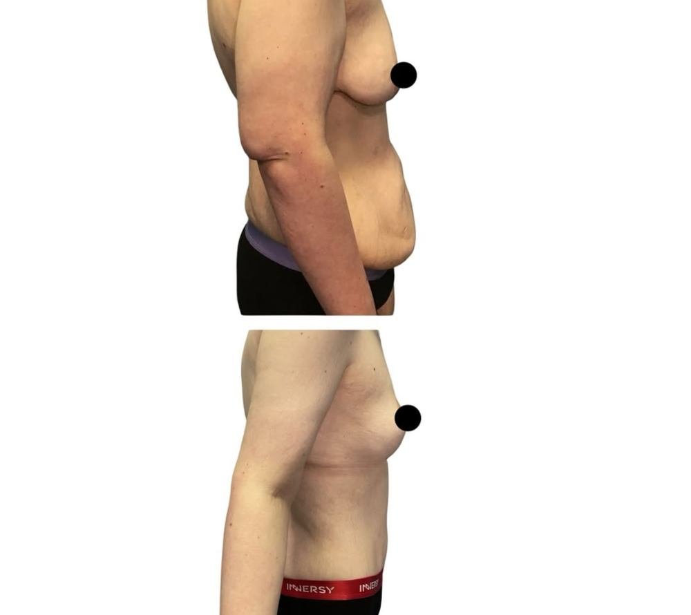 mommy-makeover-before-after-dr-gargya-tampa-05