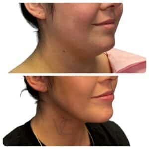 before and after deep plane facelift showing improved jawline and neck contour, performed by Dr. Vipul Gargya in Tampa