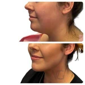 before and after couture facelift with natural jawline definition, side profile, performed by Dr. Vipul Gargya in Tampa