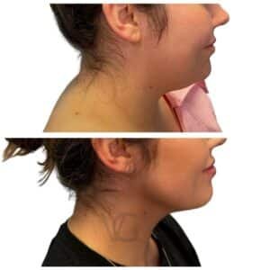 deep plane facelift before and after correcting neck laxity and lower face fullness, performed by Dr. Vipul Gargya in Tampa