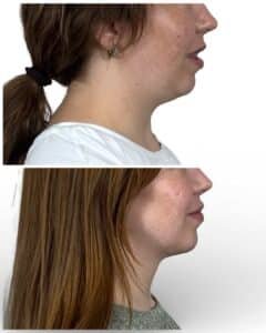 Deep Plane Neck Lift Tampa, FL by Dr. Vipul Gargya, before and after side profile showing improved jawline definition, elimination of submental fullness, and refined cervicomental angle