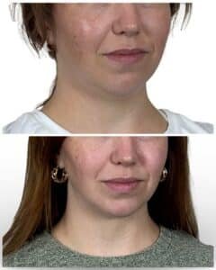 Deep Plane Neck Lift Tampa, FL by Dr. Vipul Gargya, before and after front view demonstrating tighter neck contour, enhanced jawline structure, and natural facial rejuvenation