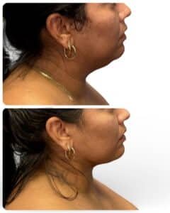 natural facelift before and after with smoother jawline and balanced facial contour, performed by Dr. Vipul Gargya in Tampa