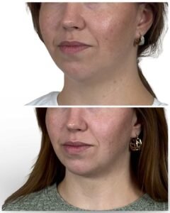 Deep Plane Neck Lift Tampa, FL by Dr. Vipul Gargya, before and after oblique view highlighting sharper jawline contour, smoother neck transition, and undetectable surgical refinement