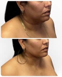 before and after deep plane facelift improving neck definition and facial harmony, performed by Dr. Vipul Gargya in Tampa