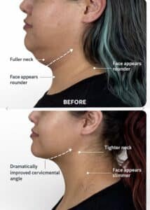 couture facelift before and after restoring jawline and reducing heaviness in the neck, performed by Dr. Vipul Gargya in Tampa