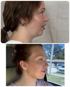 Neck lift with chin augmentation using fat transfer, lifestyle profile view showing improved jawline definition and refined chin projection, Tampa FL by Dr. Vipul Gargya