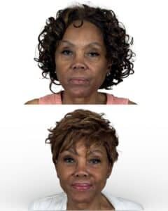 Before and after facelift, neck lift, upper and lower blepharoplasty, fat transfer, and lip lift performed by Dr. Vipul Gargya in Tampa, showing natural facial rejuvenation with improved jawline, smoother neck, brighter eyes, and balanced lips.