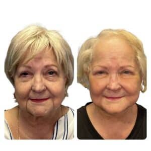 Before and after photo of a female patient following deep plane facelift, neck lift, lower blepharoplasty, and facial fat transfer. Visible improvements in jawline definition, under-eye contour, and midface volume with natural, refreshed appearance.