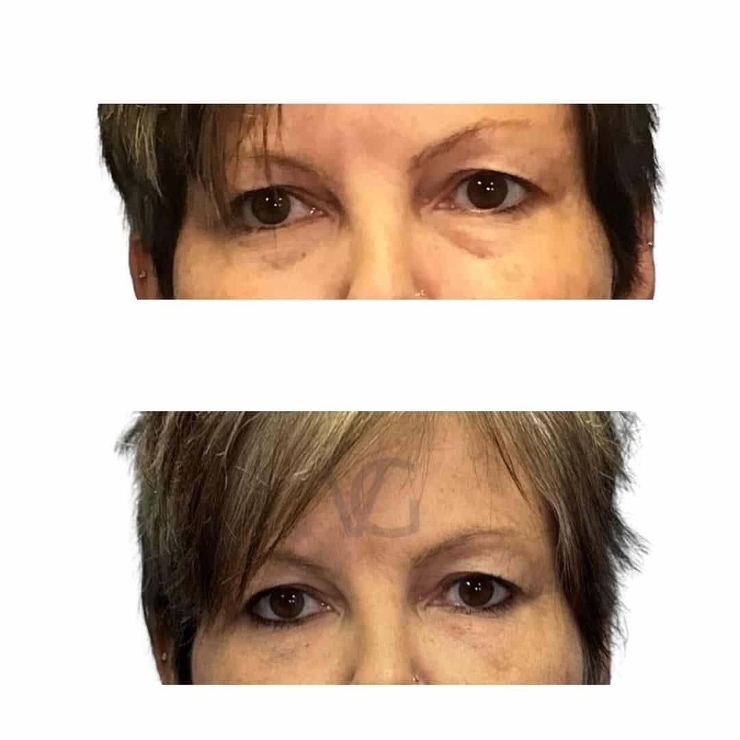 Blepharoplasty / Eye Rejuvenation