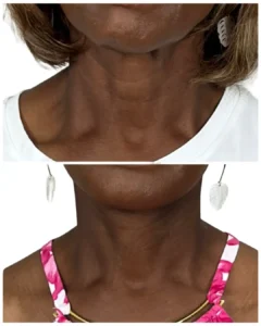 Before-and-after deep plane facelift and neck lift frontal view by Dr. Vipul Gargya in Tampa, showing improved neck contour, reduced banding, and a more defined jawline at 3 months post-op.
