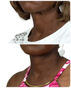 Before-and-after deep plane facelift and neck lift oblique view by Dr. Vipul Gargya in Tampa, showing improved jawline definition, smoother neck contour, and natural facial rejuvenation.