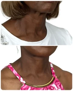 Before-and-after deep plane facelift and neck lift opposite oblique view by Dr. Vipul Gargya in Tampa, showing refined jawline and neck contour with natural-looking facial rejuvenation.