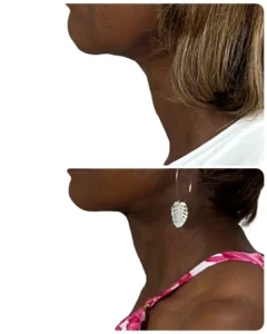 Before-and-after deep plane facelift and neck lift profile view by Dr. Vipul Gargya in Tampa, showing improved cervicomental angle, jawline definition, and smoother neck contour.