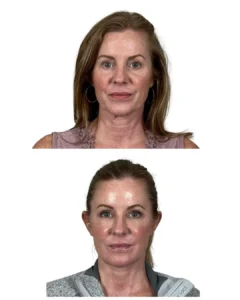 Deep plane facelift and neck lift before and after frontal view with facial fat transfer and eye rejuvenation by Dr. Vipul Gargya in Tampa, Florida.