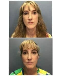 Before and after deep plane facelift with neck lift and upper blepharoplasty showing improved jawline definition, smoother neck contour, refined cervicomental angle, and brighter upper eyelid appearance in Tampa patient treated by Dr. Vipul Gargya