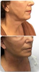 Before and after deep plane facelift and neck lift in Tampa showing dramatic improvement in jawline definition, neck contour, and lower face rejuvenation with natural, undetectable results by Dr. Vipul Gargya