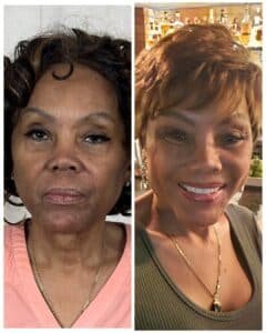 Deep plane facelift and neck lift with facial fat transfer and lip lift, before and after result showing natural facial rejuvenation and preserved expression, performed by Dr. Vipul Gargya in Tampa