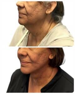 Deep plane neck lift before and after, oblique view of female patient showing improved jawline definition, reduced neck laxity, and smoother cervicomental angle by Dr. Vipul Gargya in Tampa.