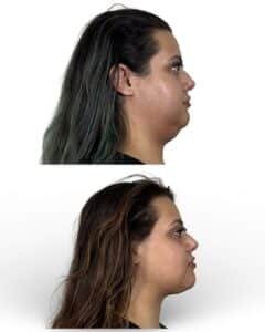 Side profile after deep plane neck lift with restored cervicomental angle, sharper jawline definition, and improved neck contour performed in Tampa by Dr. Vipul Gargya