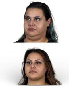 After deep plane neck lift surgery demonstrating improved jawline definition, reduced submental fullness, and smoother neck contour in Tampa patient treated by Dr. Vipul Gargya