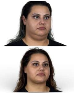 Three-quarter view after deep plane neck lift demonstrating refined jawline contour, improved neck tightness, and natural structural rejuvenation in Tampa patient