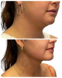 Deep plane neck lift before and after, side profile view showing improved jawline definition and neck contour in Tampa by Dr. Vipul Gargya at VG Signature