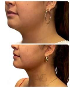 Deep plane neck lift results before and after, lateral view demonstrating correction of neck laxity and enhanced cervicomental angle, Tampa plastic surgeon Dr. Vipul Gargya