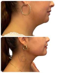 Deep plane neck lift before and after transformation, profile view highlighting smoother neckline and refined jaw contour in Tampa, Florida by Dr. Vipul Gargya