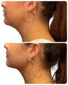 Deep plane neck lift surgical results before and after, side profile showing tightened neck tissues and improved lower face contour at VG Signature in Tampa