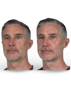 Mini facelift with facial fat transfer, oblique view before and after of male patient showing improved jawline definition, smoother neck contour, and natural facial rejuvenation by Dr. Vipul Gargya in Tampa.