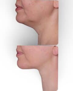 before and after deep plane facelift showing improved jawline definition and smoother neck contour
