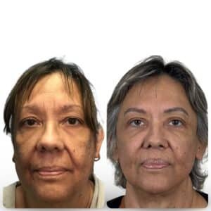 CouturaLift facelift before and after, enhanced lower face and neck definition, Tampa FL