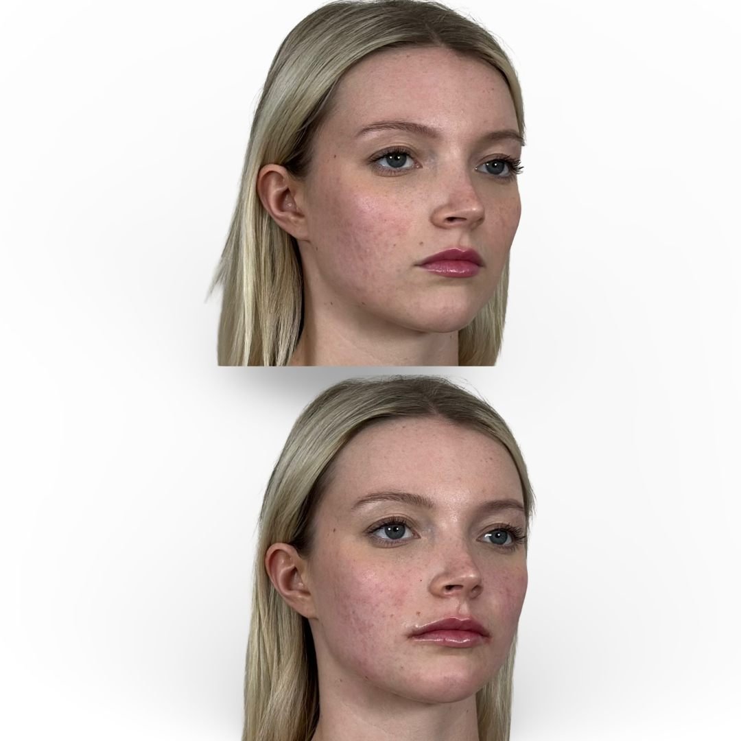 Lip Filler