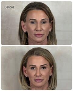 Before and after frontal view of female patient showing natural facial rejuvenation after mini facelift with facial fat grafting, with improved jawline definition and balanced midface volume.