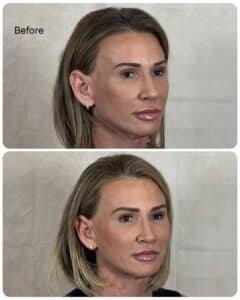 Before and after three-quarter view of female patient following mini facelift and facial fat transfer, demonstrating smoother cheek contours, improved lower face support, and natural-looking results.