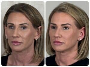 Before and after comparison of female patient after mini facelift with fat grafting to the face, showing refined jawline, restored cheek volume, and subtle facial rejuvenation without a pulled appearance.