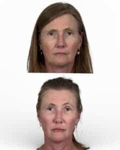 Before and after frontal view of female patient following mini facelift and facial fat grafting, highlighting improved facial balance, softer contours, and refreshed appearance.