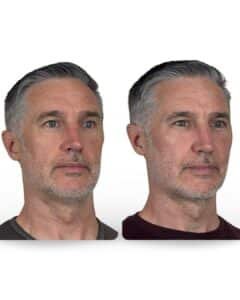 Before and after three-quarter view of male patient after facelift procedure, showing improved jawline definition, smoother neck contour, and natural facial rejuvenation.