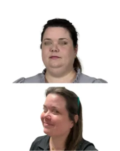 Neck lift and buccal fat removal before and after in Tampa showing improved jawline definition, reduced lower-face fullness, and a smoother neck contour by Dr. Vipul Gargya.