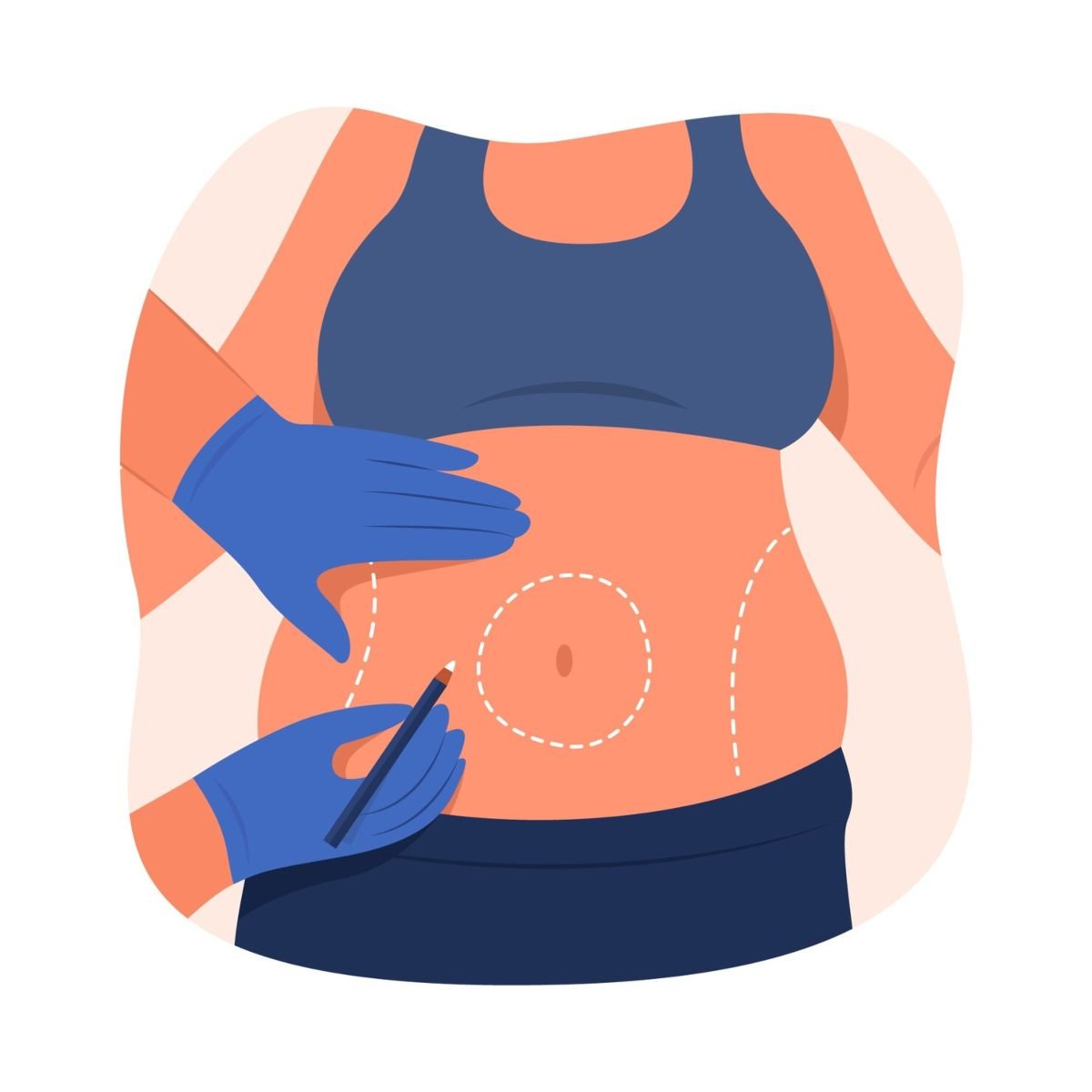 What Is the Maximum Fat That Can Be Removed During Liposuction?