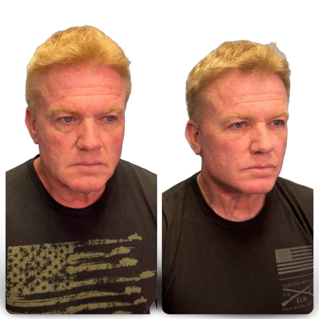 CouturaLift™ (Couture Facelift) / Deep Plane Facelift Tampa