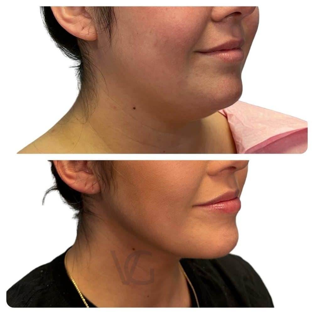 Transform Your Profile with ChinSculpt™ in Tampa