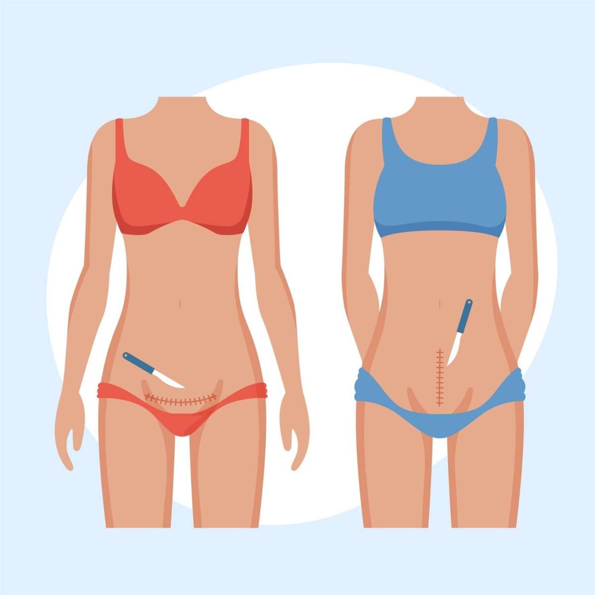 360° Tummy Tuck vs. Traditional Tummy Tuck: Which Is Right for You in Tampa?