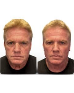 Facelift before and after showing jawline sculpting and midface support, CouturaLift Tampa