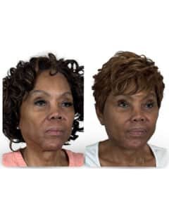 High-end deep plane facelift technique, natural lift and refined structure, VG Signature