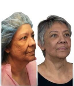 Deep plane facelift with natural rejuvenation, couture facelift outcome by Dr Gargya