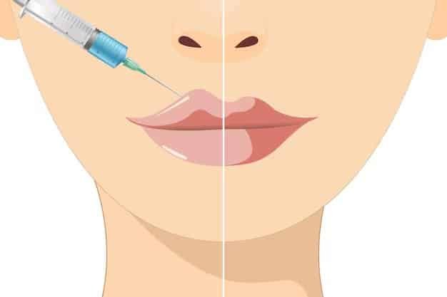 Tired of Fillers? How a Lip Lift Solves What Injections Can’t