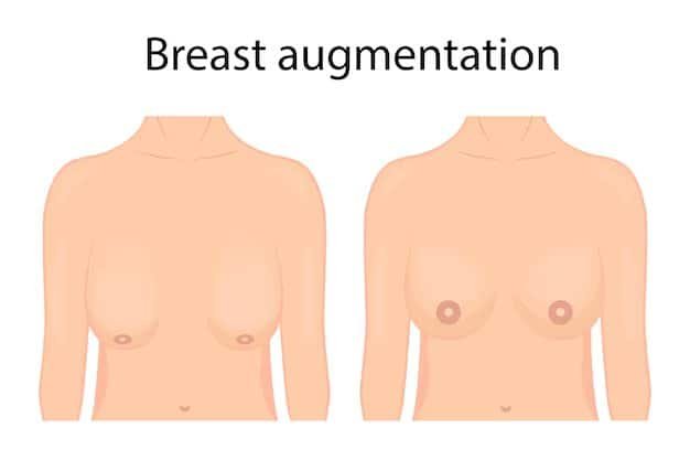 Tiny Boob Job vs Traditional Breast Augmentation: Subtle vs Obvious Results