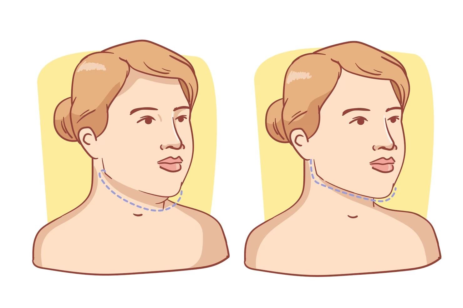 Neck Lift vs Kybella: Which Is Better for a Double Chin?